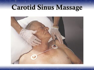 Carotid Sinus Massage
 