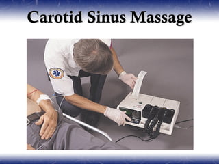 Carotid Sinus Massage
 