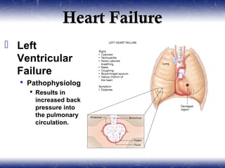 Heart Failure
 Left
  Ventricular
  Failure
   Pathophysiology
     Results in
      increased back
      pressure into
      the pulmonary
      circulation.
 