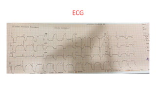 ECG
 