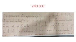 2ND ECG
 