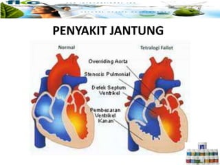 PENYAKIT JANTUNG
 