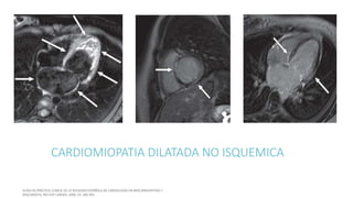 CARDIOMIOPATIA DILATADA NO ISQUEMICA
 