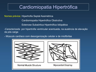Cardiomiopatia Hipertrófica
Nomes prévios: Hipertrofia Septal Assimétrica
                Cardiomiopatia Hipertrófica Obstrutiva
                Estenose Subaórtica Hipertrófica Idiópática
-Caracterizada por hipertrofia ventricular acentuada, na ausência de elevação
da pós carga
- Músculo cardíaco com desorganização celular e de miofibrilas
 