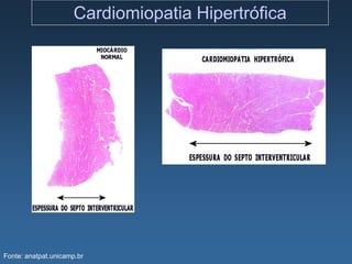 Cardiomiopatia Hipertrófica




Fonte: anatpat.unicamp.br
 