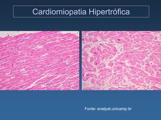 Cardiomiopatia Hipertrófica




              Fonte: anatpat.unicamp.br
 