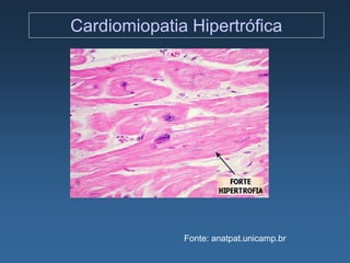 Cardiomiopatia Hipertrófica




              Fonte: anatpat.unicamp.br
 