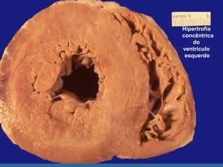 Hipertrofia
concêntrica
    do
ventrículo
 esquerdo
 