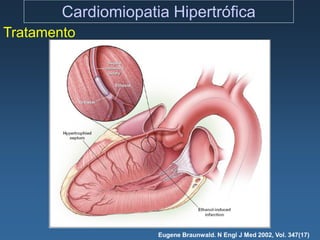 Cardiomiopatia Hipertrófica
Tratamento




                     Eugene Braunwald. N Engl J Med 2002, Vol. 347(17)
 