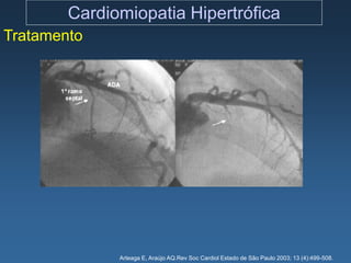 Cardiomiopatia Hipertrófica
Tratamento




              Arteaga E, Araújo AQ.Rev Soc Cardiol Estado de São Paulo 2003; 13 (4):499-508.
 