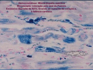 Hemocromatose: Miocardiopatia restritiva
         Microscopia, coloração pelo azul da Prússia.
Excessivo depósito de ferro, levando ao aumento do coração e,
                     à falência cardíaca.
 