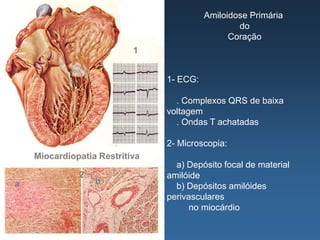 Amiloidose Primária
                                                  do
                                                Coração
                           1


                                1- ECG:

                                  . Complexos QRS de baixa
                                voltagem
                                  . Ondas T achatadas

                                2- Microscopia:
    Miocardiopatia Restritiva
                                  a) Depósito focal de material
              2                 amilóide
a                 b
                                  b) Depósitos amilóides
                                perivasculares
                                      no miocárdio
 