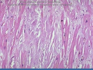 Miocardiopatia restritiva: Amiloidose
Depósito amorfo de material rosa pálido entre os miócitos.
 