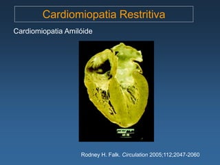 Cardiomiopatia Restritiva
Cardiomiopatia Amilóide




                   Rodney H. Falk. Circulation 2005;112;2047-2060
 