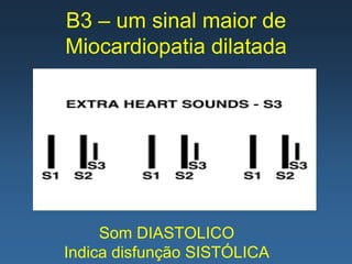 B3 – um sinal maior de
Miocardiopatia dilatada




     Som DIASTOLICO
Indica disfunção SISTÓLICA
 