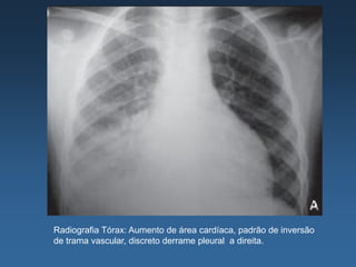 Radiografia Tórax: Aumento de área cardíaca, padrão de inversão
de trama vascular, discreto derrame pleural a direita.
 