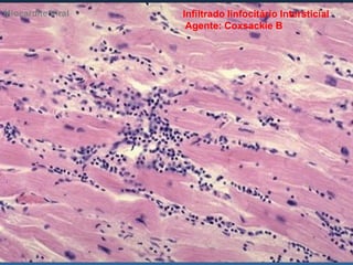 Miocardite Viral   Infiltrado linfocitário Intersticial
                    Agente: Coxsackie B
 