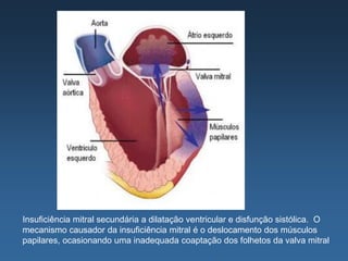 Insuficiência mitral secundária a dilatação ventricular e disfunção sistólica. O
mecanismo causador da insuficiência mitral é o deslocamento dos músculos
papilares, ocasionando uma inadequada coaptação dos folhetos da valva mitral
 