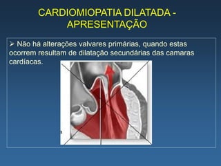 CARDIOMIOPATIA DILATADA -
            APRESENTAÇÃO
 Não há alterações valvares primárias, quando estas
ocorrem resultam de dilatação secundárias das camaras
cardíacas.
 