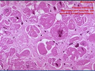 Microscopia

           Fibrose intersticial.
 Hipertrofia dos miócitos, que
possuem núcleo proeminente.
 