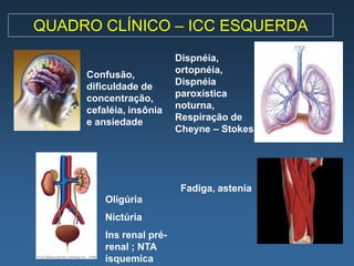 QUADRO CLÍNICO – ICC ESQUERDA
                          Dispnéia,
     Confusão,            ortopnéia,
     dificuldade de       Dispnéia
     concentração,        paroxística
     cefaléia, insônia    noturna,
     e ansiedade          Respiração de
                          Cheyne – Stokes




                           Fadiga, astenia
         Oligúria
         Nictúria
         Ins renal pré-
         renal ; NTA
         isquemica
 