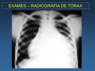 EXAMES – RADIOGRAFIA DE TÓRAX
 
