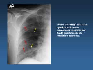 Linhas de Kerley: são finas
opacidades lineares
pulmonares causadas por
fluido ou infiltração do
interstício pulmonar.
 
