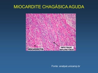 MIOCARDITE CHAGÁSICA AGUDA




             Fonte: anatpat.unicamp.br
 