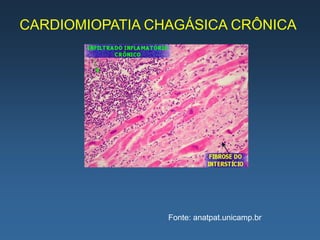 CARDIOMIOPATIA CHAGÁSICA CRÔNICA




                 Fonte: anatpat.unicamp.br
 