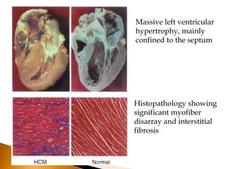 Massive left ventricular
hypertrophy, mainly
confined to the septum




Histopathology showing
significant myofiber
disarray and interstitial
fibrosis
 