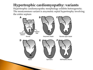Hypertrophic cardiomyopathy: variants
Hypertrophic cardiomyopathy morphology exhibits heterogeneity.
The mostcommon variant is assymetric septal hypertrophy involving
the entire septum
 