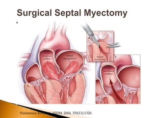 Nishimura RA et al. NEJM. 2004. 350(13):1320.
 