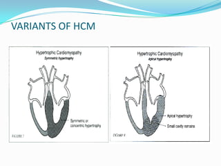 VARIANTS OF HCM
 