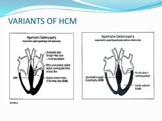 VARIANTS OF HCM
 