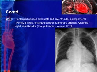 Contd…
CXR : - Enlarged cardiac silhouette (d/t biventricular enlargement)
-Kerley B lines, enlarged central pulmonary arteries, widened
right heart border ( E/o pulmonary venous HTN)
11
 