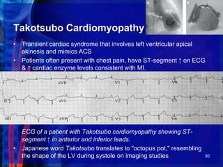 Takotsubo Cardiomyopathy
• Transient cardiac syndrome that involves left ventricular apical
akinesis and mimics ACS
• Patients often present with chest pain, have ST-segment ↑ on ECG
& ↑ cardiac enzyme levels consistent with MI.
ECG of a patient with Takotsubo cardiomyopathy showing ST-
segment ↑ in anterior and inferior leads.
• Japanese word Takotsubo translates to "octopus pot," resembling
the shape of the LV during systole on imaging studies 30
 
