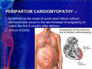 PERIPARTUM CARDIOMYOPATHY :-
• is defined as the onset of acute heart failure without
demonstrable cause in the last trimester of pregnancy or
within the first 5 months after delivery.
• A form of DCM.
32
 