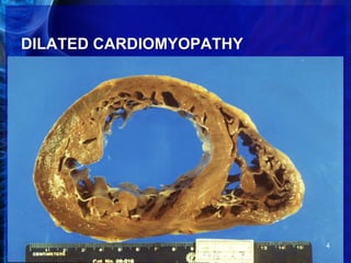 DILATED CARDIOMYOPATHY
4
 