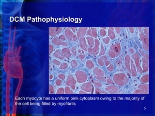 DCM Pathophysiology
Each myocyte has a uniform pink cytoplasm owing to the majority of
the cell being filled by myofibrils
5
 