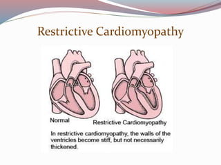 Restrictive Cardiomyopathy
 