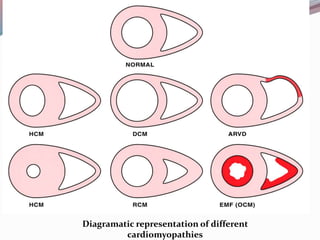 Diagramatic representation of different
cardiomyopathies
 