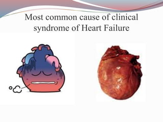 Most common cause of clinical
syndrome of Heart Failure
 