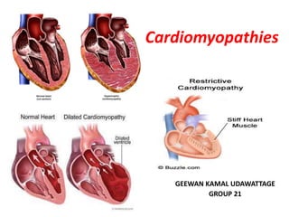 Cardiomyopathies
GEEWAN KAMAL UDAWATTAGE
GROUP 21
 