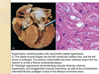 Cardiomyopathies | PPTX | Heart and Cardiovascular Diseases | Diseases ...