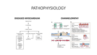 PATHOPHYSIOLOGY
DISEASED MYOCARDIUM CHANNELOPATHY
 