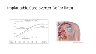 Implantable Cardioverter Defibrillator
 
