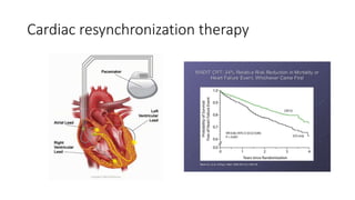 Cardiac resynchronization therapy
 