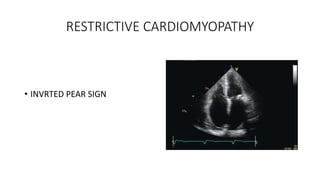 RESTRICTIVE CARDIOMYOPATHY
• INVRTED PEAR SIGN
 