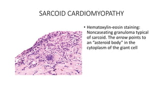 SARCOID CARDIOMYOPATHY
• Hematoxylin-eosin staining:
Noncaseating granuloma typical
of sarcoid. The arrow points to
an “asteroid body” in the
cytoplasm of the giant cell
 