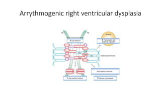 Arrythmogenic right ventricular dysplasia
 